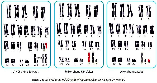 Bộ nhiễm sắc thể của một số hội trứng ở người do đột biến lệch bội